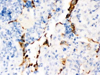 IHC testing of FFPE human lung cancer tissue with Kv1.4 antibody. HIER: Boil the paraffin sectio