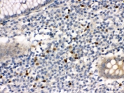 IHC testing of FFPE human appendicitis tissue with MMP-8 antibody. HIER: Boil the paraffin sections in pH 6, 10mM citrate buffer for 20 minutes and allow to cool prior to staining.