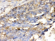 IHC testing of FFPE human intestinal cancer tissue with Cofilin antibody. HIER: Boil the paraffin sections in pH 6, 10mM citrate buffer for 20 minutes and allow to cool prior to staining.