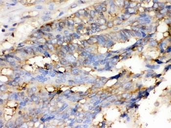 IHC testing of FFPE human intestinal cancer tissue with Cofilin antibody. HIER: Boil the paraffin sections in pH 6, 10mM citrate buffer for 20 minutes and allow to cool prior to staining.