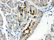IHC testing of FFPE human pancreatic cancer tissue with PAX6 antibody. HIER: Boil the paraffin sections in pH 6, 10mM citrate buffer for 20 minutes and allow to cool prior to staining.