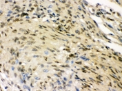 IHC testing of FFPE human meningeoma tissue with HuD antibody. HIER: Boil the paraffin sections in pH 6, 10mM citrate buffer for 20 minutes and allow to cool prior to staining.