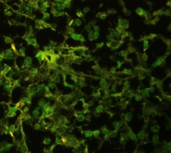 Immunofluorescent staining of FFPE human glioma with HuD antibody. HIER: boil tissue sections in pH6, 10mM citrate buffer, for 20 min and allow to cool before testing.