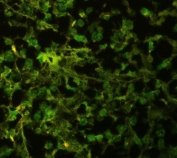 <BR>Immunofluorescent staining of FFPE human glioma with HuD antibody. HIER: boil tissue sections in pH6, 10mM citrate buffer, for 20 min and allow to cool before testing.<BR>