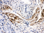 IHC testing of FFPE human lung cancer with MAOB antibody. HIER: Boil the paraffin sections in pH 6, 10mM citrate buffer for 20 minutes and allow to cool prior to staining.