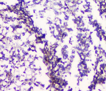 IHC staining of FFPE human glioma with 5HT2AR antibody at 1ug/ml. HIER: boil tissue sections in pH6, 10mM citrate buffer, for 10-20 min followed by cooling at RT for 20 min.