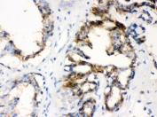 IHC testing of FFPE human breast cancer tissue with CTGF antibody. HIER: Boil the paraffin sections in pH 6, 10mM citrate buffer for 20 minutes and allow to cool prior to staining.