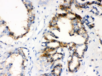 IHC testing of FFPE human breast cancer tissue with CTGF antibody. HIER: Boil the paraffin sections in p