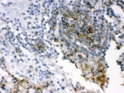 IHC testing of FFPE human lung cancer using SHC antibody. HIER: Boil the paraffin sections in pH 6, 10mM citrate buffer for 20 minutes and allow to cool prior to staining.