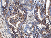 IHC staining of FFPE human rectal cancer tissue with Aquaporin 1 antibody. HIER: boil tissue sections in pH8 EDTA for 20 min and allow to cool before testing.