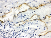 IHC testing of FFPE human intestinal cancer with Aquaporin 1 antibody. HIER: Boil the paraffin sections in pH 6, 10mM citrate buffer for 20 minutes and allow to cool prior to staining.