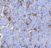 IHC staining of FFPE human liver cancer tissue with Aquaporin 1 antibody. HIER: boil tissue sections in pH8 EDTA for 20 min and allow to cool before testing.