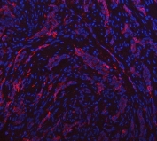 Immunofluorescent staining of FFPE human lung cancer tissue with Aquaporin 1 antibody. HIER: boil tissue sections in pH8 EDTA for 20 min and allow to cool before testing.