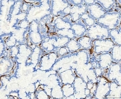 IHC staining of FFPE human lung cancer tissue with Aquaporin 1 antibody. HIER: boil tissue sections in pH8 EDTA for 20 min and allow to cool before testing.