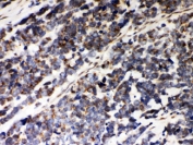 IHC testing of FFPE human lung cancer with Peroxiredoxin 5 antibody. HIER: Boil the paraffin sections in pH 6, 10mM citrate buffer for 20 minutes and allow to cool prior to staining.