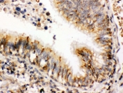IHC testing of FFPE human lung cancer tissue with PDIA3 antibody. HIER: Boil the paraffin sections in pH 6, 10mM citrate buffer for 20 minutes and allow to cool prior to staining.