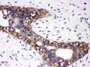 IHC testing of FFPE human breast cancer tissue with AT1R antibody. HIER: Boil the paraffin sections in pH 6, 10mM citrate buffer for 20 minutes and allow to cool prior to staining.