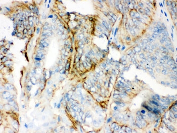 IHC testing of FFPE human intestinal cance with PKLR antibody. HIER: Boil the paraffin sections in pH 6, 10mM citrate buffer for 20 minutes and allow to cool prior to staining.~