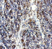 IHC staining of FFPE human breast cancer tissue with SDHA antibody. HIER: boil tissue sections in pH8 EDTA for 20 min and allow to cool before testing.