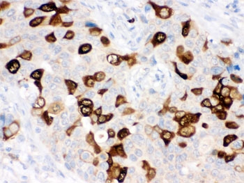 IHC testing of FFPE human breast cancer tissue with RRM2 antibody. HIER: Boil the para