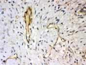 IHC testing of FFPE human breast cancer with Syndecan 4 antibody. HIER: Boil the paraffin sections in pH 6, 10mM citrate buffer for 20 minutes and allow to cool prior to staining.