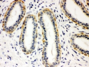IHC testing of FFPE human breast cancer tissue with SERT antibody. HIER: Boil the paraffin sections in pH 6, 10mM citrate buffer for 20 minutes and allow to cool prior to staining.