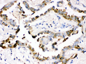 IHC testing of FFPE human lung cancer tissue with Surfactant protein D antibody. HIER: Boil the paraffin sections in pH 6, 10mM citrate buffer for 20 minutes and allow to cool prior to staining.