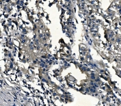 IHC staining of FFPE human liver cancer with ADRA1A antibody. HIER: boil tissue sections in pH6, 10mM citrate buffer, for 20 min and allow to cool before testing.