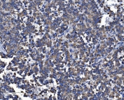 IHC testing of FFPE human malignant melanoma tissue with GRP75 antibody. HIER: Boil the paraffin sections in pH8 EDTA buffer for 20 minutes and allow to cool prior to staining.