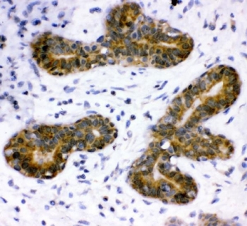 IHC staining of FFPE human breast cancer tissue with STAT3 antibody. HIER: boil tissue sections in pH8 EDTA for 20 min and allow to cool before testing.~