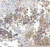IHC staining of FFPE human tumor tissue with STAT3 antibody, HRP-secondary and DAB substrate. HIER: boil tissue sections in pH8 EDTA for 20 min and allow to cool before testing.