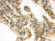 IHC testing of FFPE human kidney cancer tissue with Aquaporin 2 antibody. HIER: Boil the paraffin sections in pH 6, 10mM citrate buffer for 20 minutes and allow to cool prior to staining.