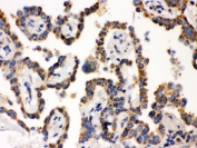 IHC testing of FFPE human lung cancer tissue with WASP antibody. HIER: Boil the paraffin sections in pH 6, 10mM citrate buffer for 20 minutes and allow to cool prior to staining.