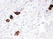 IHC testing of FFPE human osteosarcoma tissue with CTSK antibody. HIER: Boil the paraffin sections in pH 6, 10mM citrate buffer for 20 minutes and allow to cool prior to staining.