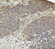 IHC staining of FFPE human liver cancer tissue with MKK3 antibody. HIER: boil tissue sections in pH8 EDTA for 20 min and allow to cool before testing.