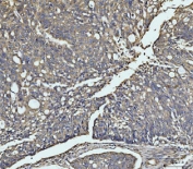 IHC staining of FFPE human ovarian cancer tissue with MKK3 antibody. HIER: boil tissue sections in pH8 EDTA for 20 min and allow to cool before testing.