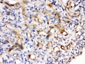 IHC testing of FFPE human melanoma tissue with Nestin antibody. HIER: Boil the paraffin sections in pH 6, 10mM citrate buffer for 20 minutes and allow to cool prior to staining.