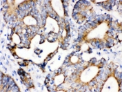 IHC testing of FFPE human intestinal cancer tissue with IDH2 antibody. HIER: Boil the paraffin sections in pH 6, 10mM citrate buffer for 20 minutes and allow to cool prior to staining.