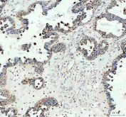 IHC staining of FFPE human ovarian cancer tissue with IDH2 antibody. HIER: boil tissue sections in pH8 EDTA for 20 min and allow to cool before testing.