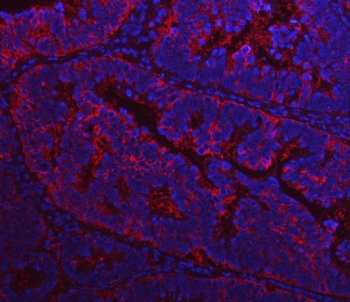 Immunofluorescent staining of FFPE human rectal cancer tissue with FASN antibody (red) and DAPI nuclear stain (blue). HIER: steam section in pH8 EDTA buffer for 20 min.