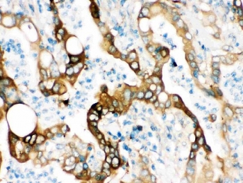 IHC testing of FFPE human intestinal cancer tissue with FASN antibody. HIER: Boil the paraffin sections in pH8 EDTA buffer for 20 minutes and allow to cool prior to staining.