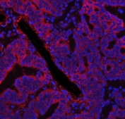Immunofluorescent staining of FFPE human ovarian cancer tissue with FASN antibody (red) and DAPI nuclear stain (blue). HIER: steam section in pH8 EDTA buffer for 20 min.