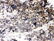 IHC testing of FFPE human lung cancer with CTCF antibody. HIER: Boil the paraffin sections in pH 6, 10mM citrate buffer for 20 minutes and allow to cool prior to staining.