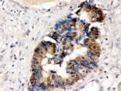 IHC testing of FFPE human intestinal cancer tissue with HINT1 antibody. HIER: Boil the paraffin sections in pH 6, 10mM citrate buffer for 20 minutes and allow to cool prior to staining.