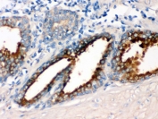 IHC testing of FFPE human prostate cancer tissue with GNAQ antibody. HIER: Boil the paraffin sections in pH 6, 10mM citrate buffer for 20 minutes and allow to cool prior to staining.