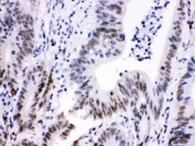 IHC testing of FFPE human intestinal cancer with Cdk9 antibody. HIER: Boil the paraffin sections in pH 6, 10mM citrate buffer for 20 minutes and allow to cool prior to staining.