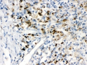 IHC testing of FFPE human intestinal cancer tissue with PPT1 antibody. HIER: Boil the paraffin sections in pH 6, 10mM citrate buffer for 20 minutes and allow to cool prior to staining.