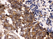 IHC testing of FFPE human lung cancer with PLK1 antibody. HIER: Boil the paraffin sections in pH 6, 10mM citrate buffer for 20 minutes and allow to cool prior to staining.