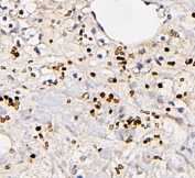 IHC testing of FFPE human renal cancer tissue with Fos B antibody. HIER: Boil the paraffin sections in pH8 EDTA for 20 minutes and allow to cool prior to staining.