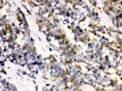 IHC testing of FFPE human lung cancer with ATXN3 antibody. HIER: Boil the paraffin sections in pH 6, 10mM citrate buffer for 20 minutes and allow to cool prior to staining.